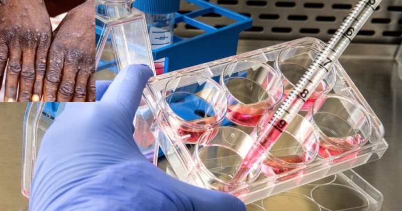 indias-first-monkeypox-case-reported-in-kerala-thiruvananthapuram-suspected-monkeypox-case-found-in-kerala-samples-sent-for-testing