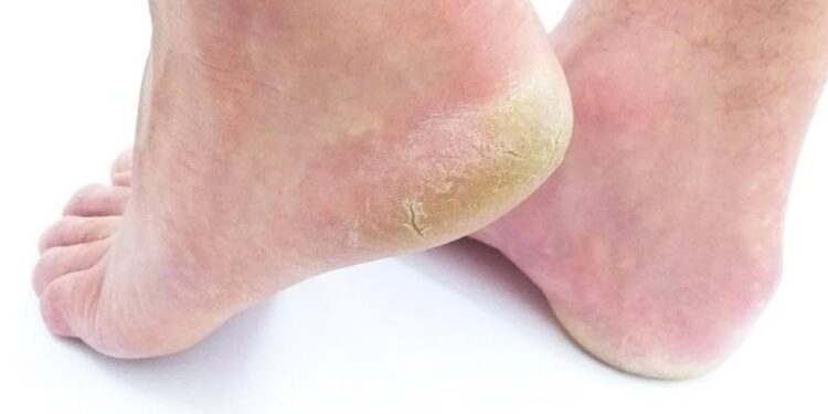 cracked heels ayurvedic-remedies